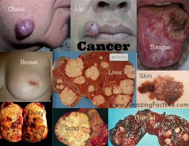 Cancer - Amazing Facts 4 u