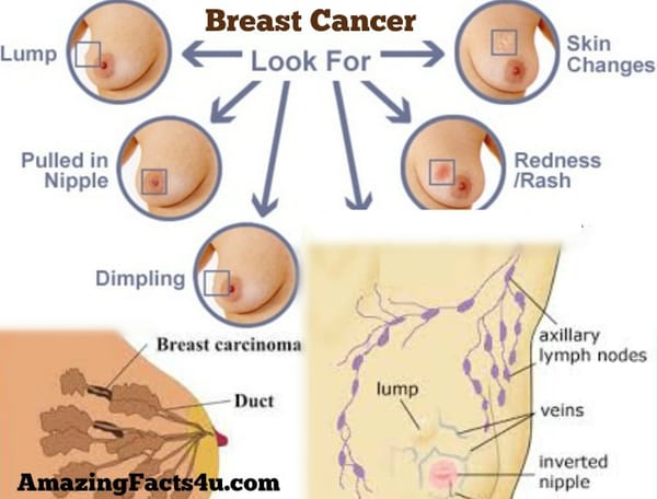 Breast Cancer Amazing Facts
